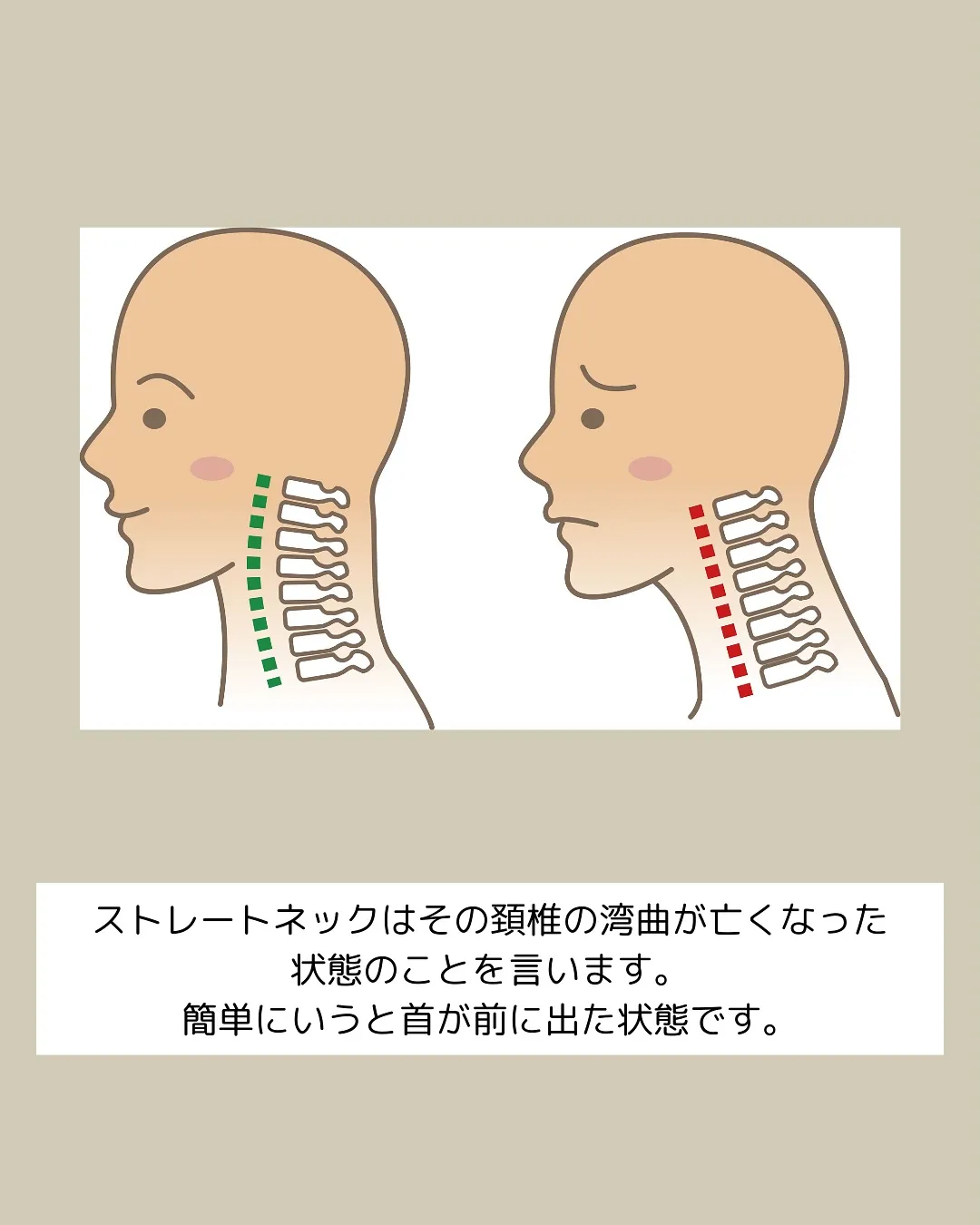 【ストレートネックって何？】