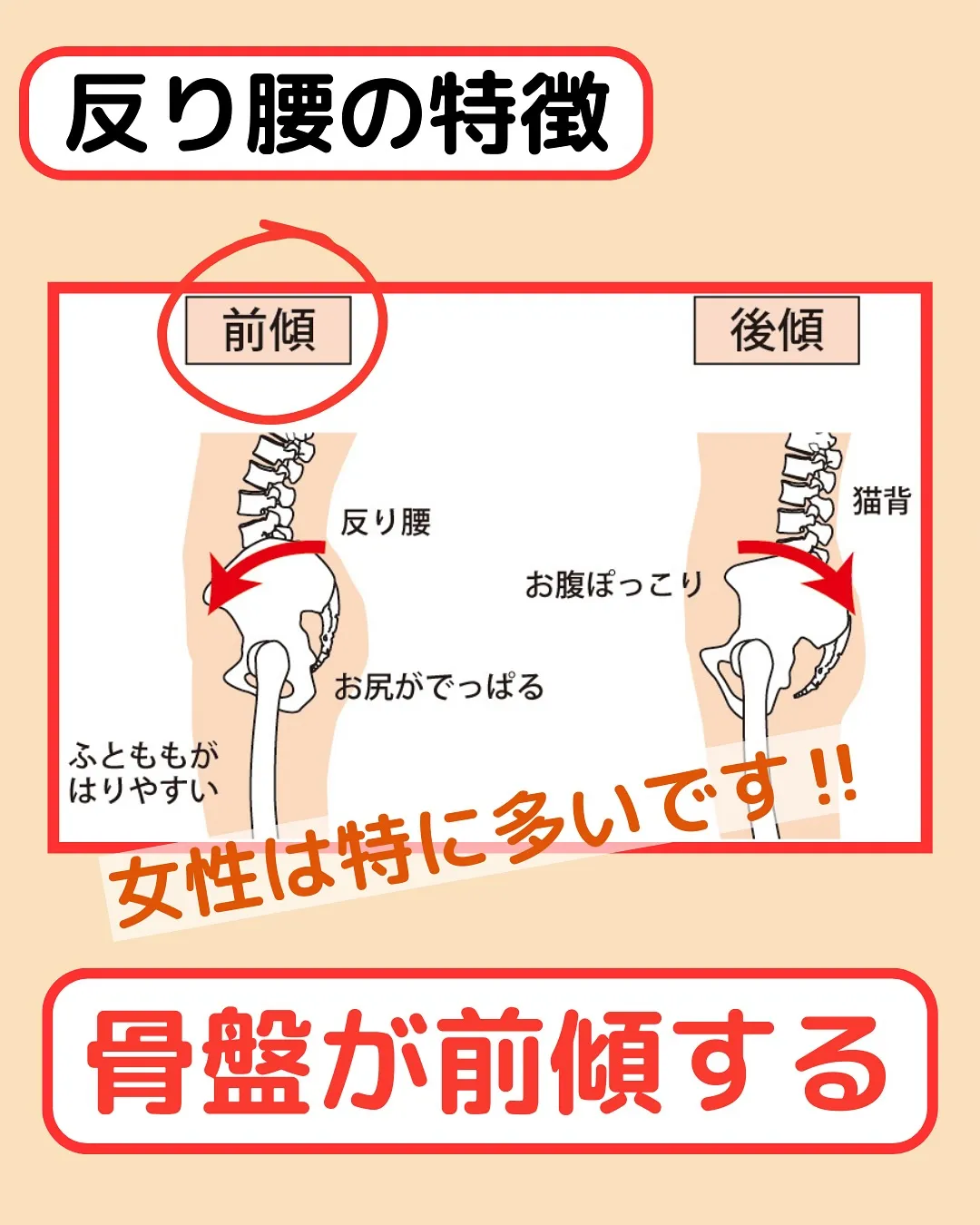 【姿勢改善‼️反り腰改善Part1✨】