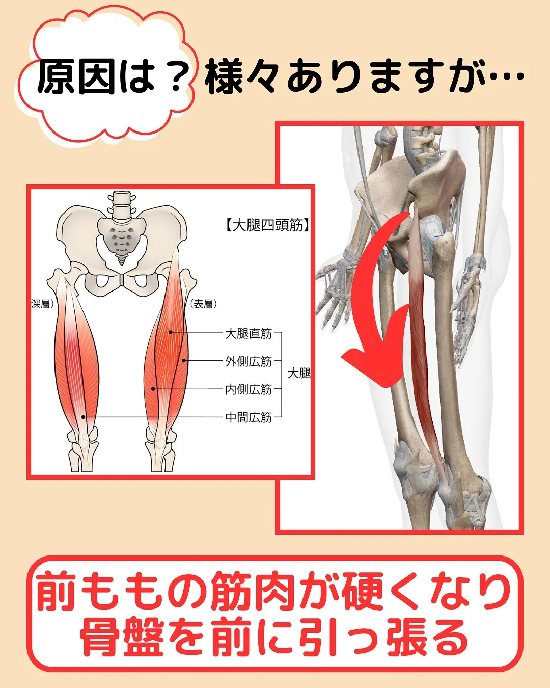 【姿勢改善‼️反り腰改善Part1✨】